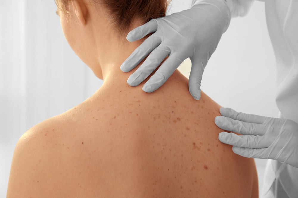 Skin Cancer Misdiagnosis & Errors